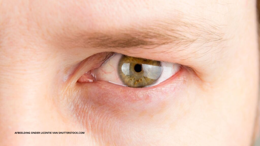ooglidcorrectie